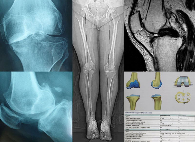 Φυλλάδιο πρακτικών οδηγιών για ασθενείς που θα υποβληθούν σε ολική αρθροπλαστική γόνατος